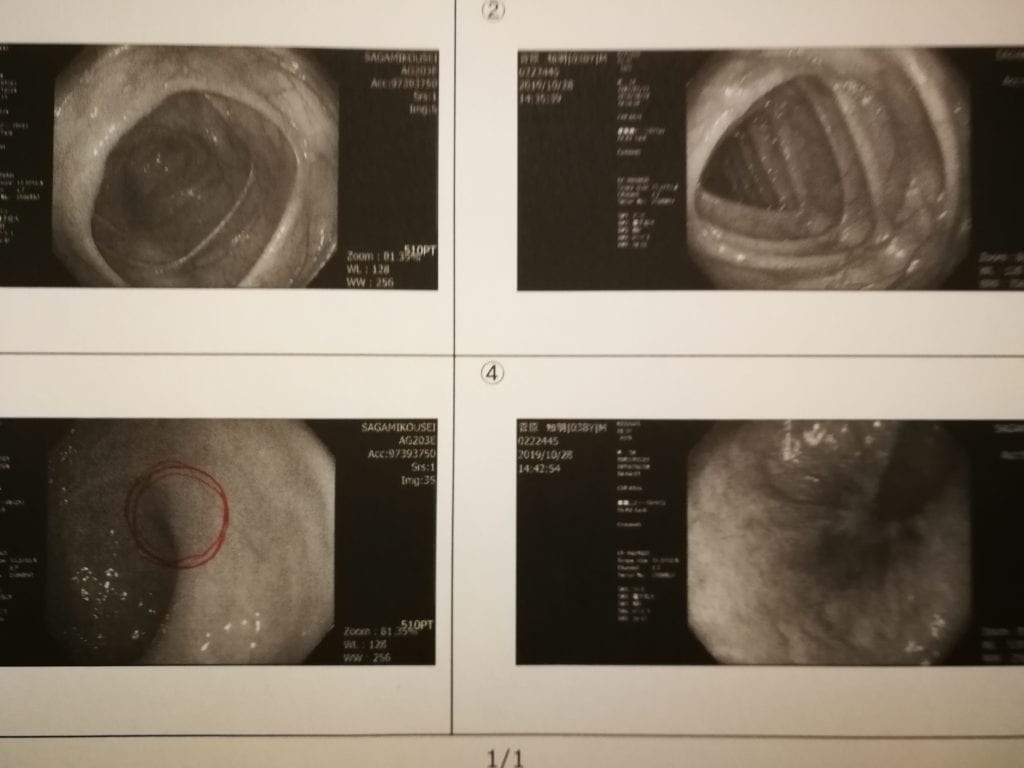 大腸内視鏡検査の写真